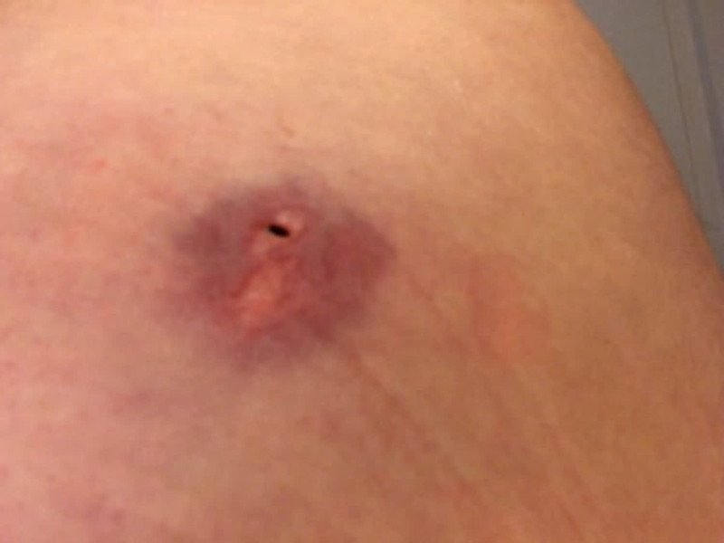 Hình ảnh mô tả quá trình viêm nhiễm và hình thành ổ mủ dưới da