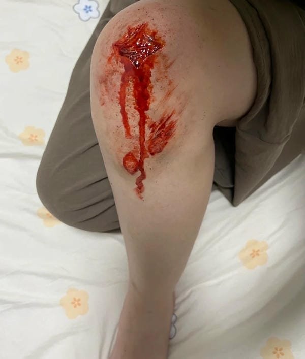 ảnh ngã xe xước tay chân 1