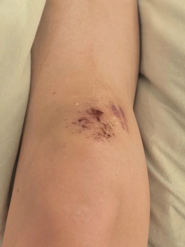 ảnh ngã xe xước tay chân 10