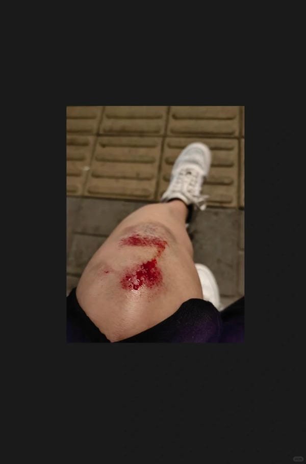 ảnh ngã xe xước tay chân 11