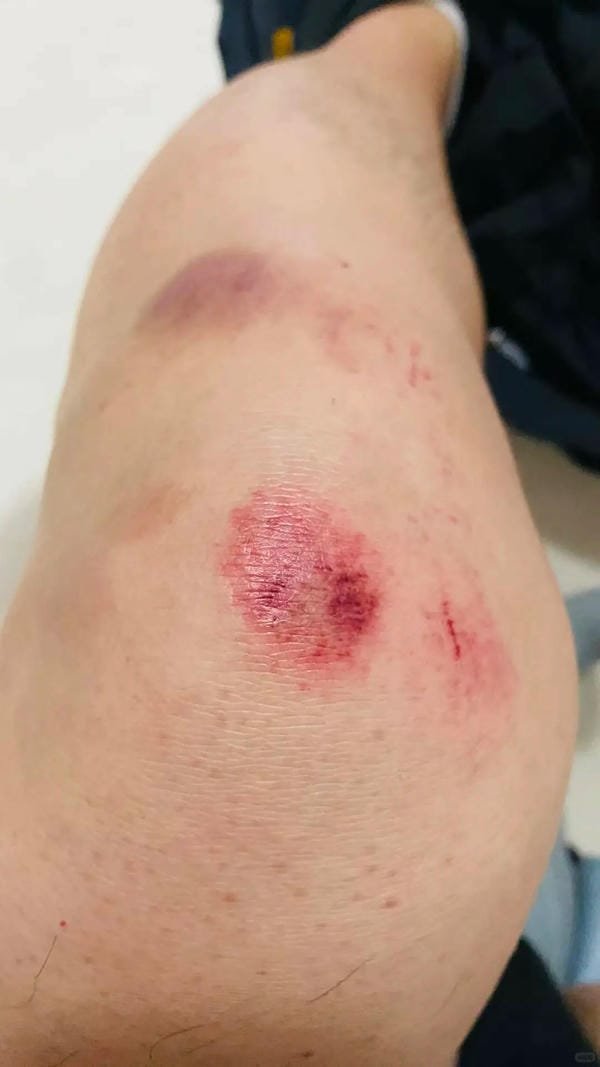 ảnh ngã xe xước tay chân 12