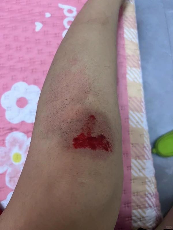 ảnh ngã xe xước tay chân 13