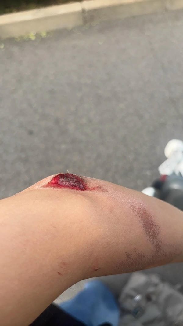 ảnh ngã xe xước tay chân 14