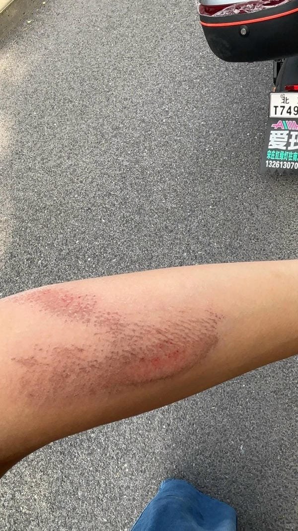 ảnh ngã xe xước tay chân 15