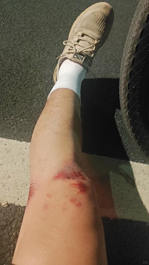 ảnh ngã xe xước tay chân 16