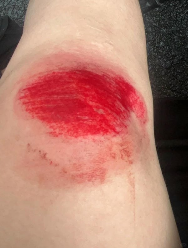 ảnh ngã xe xước tay chân 17