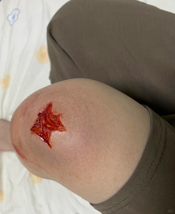 ảnh ngã xe xước tay chân 2