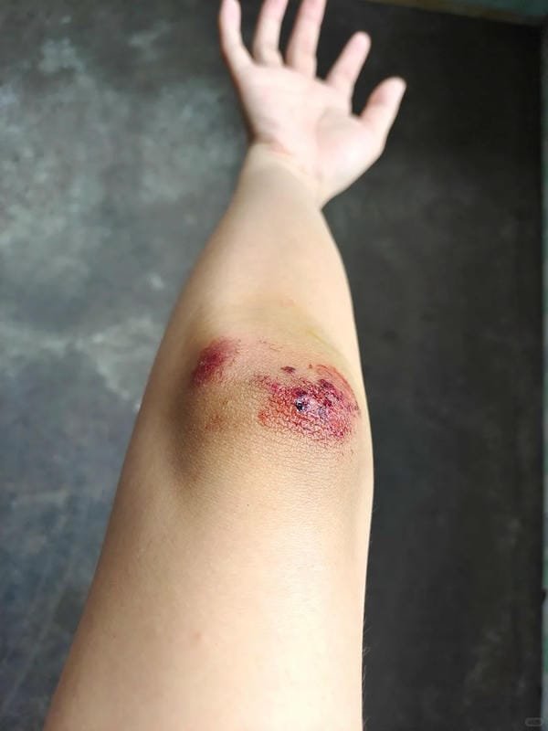 ảnh ngã xe xước tay chân 3