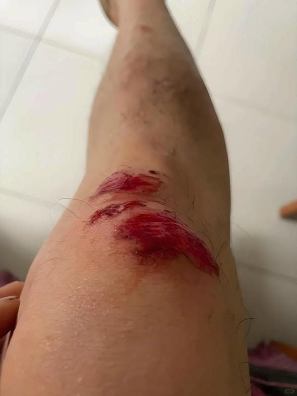 ảnh ngã xe xước tay chân 4