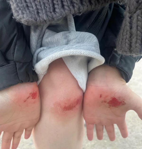 ảnh ngã xe xước tay chân 5