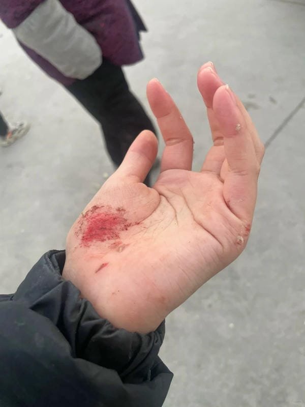 ảnh ngã xe xước tay chân 6