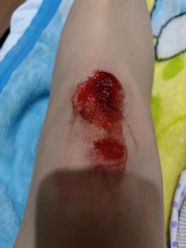 ảnh ngã xe xước tay chân 7