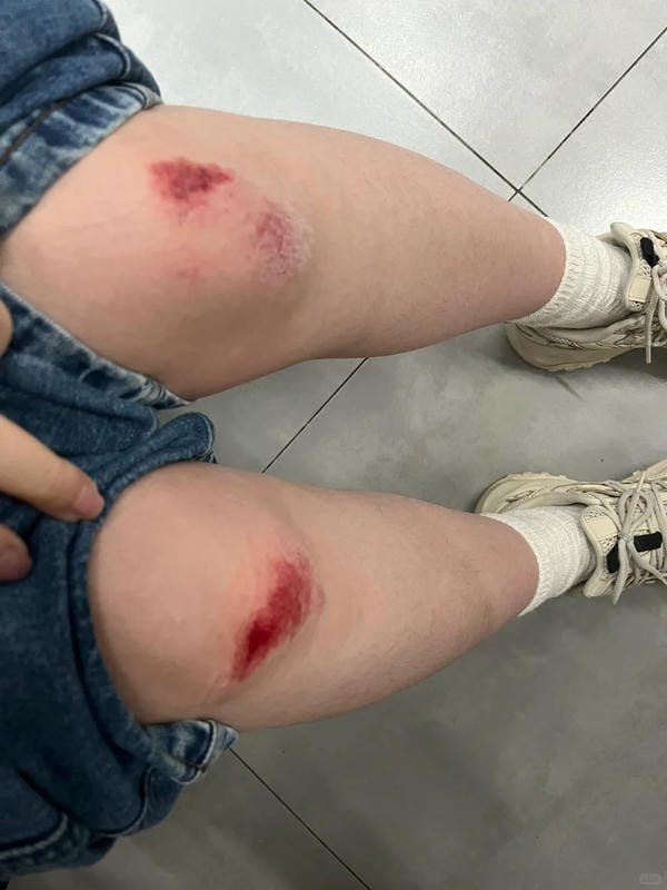 ảnh ngã xe xước tay chân 8