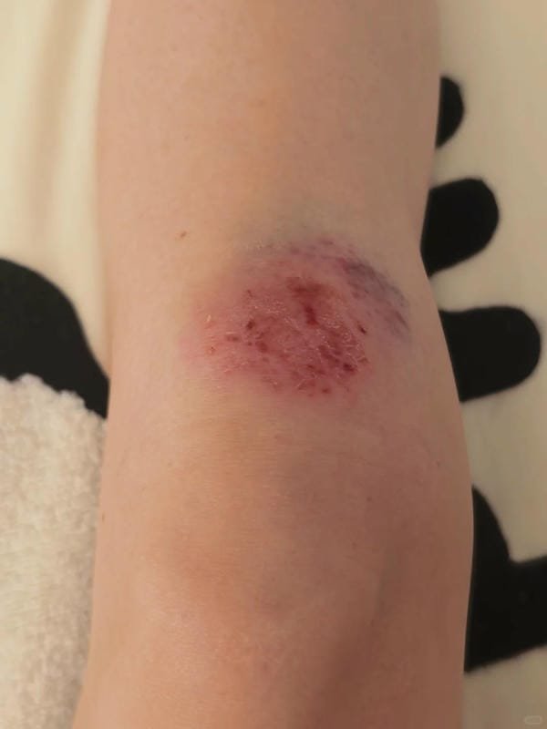 ảnh ngã xe xước tay chân 9