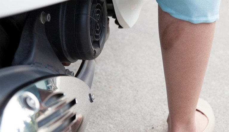 Băng bó vết thương bỏng bằng vật liệu chuyên dụng để tránh nhiễm trùng