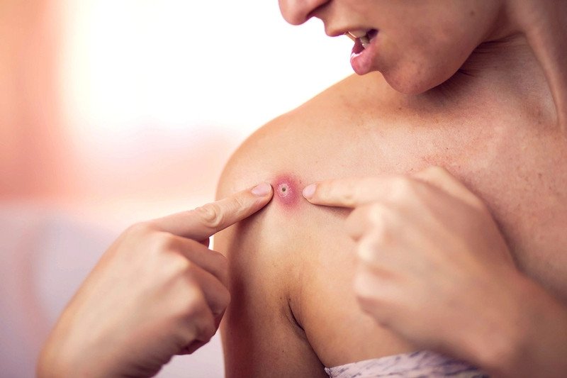 Hình ảnh mô phỏng quá trình phẫu thuật dẫn lưu mủ từ ổ áp xe