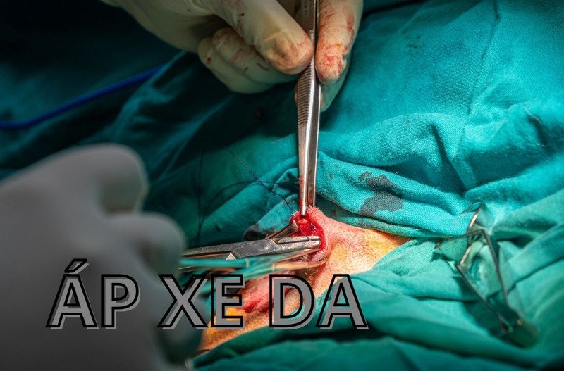 Hình ảnh một người đang chăm sóc vết thương áp xe bằng băng gạc sạch sẽ