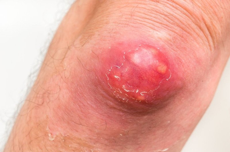 Mô tả hình ảnh về một ổ áp xe da đang sưng đỏ và có mủ