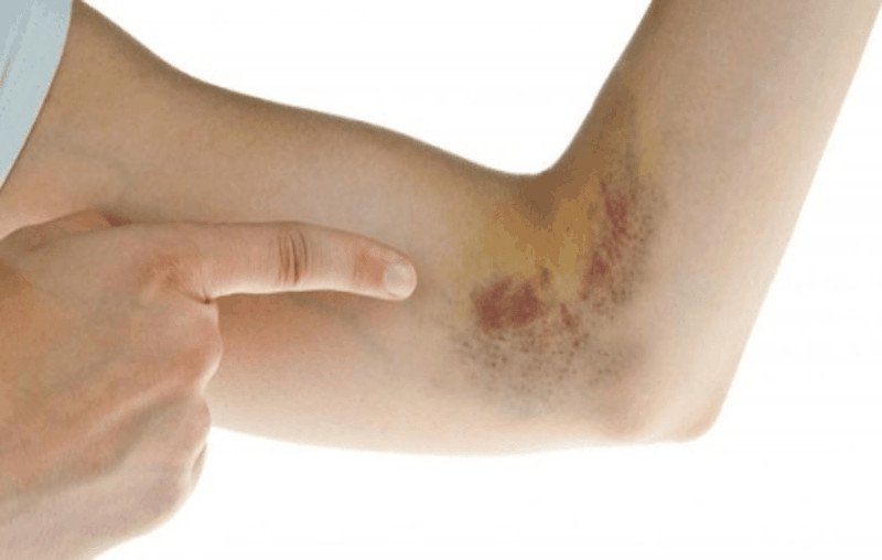 Sơ cứu vết bầm tím trên da sau khi ngã xe