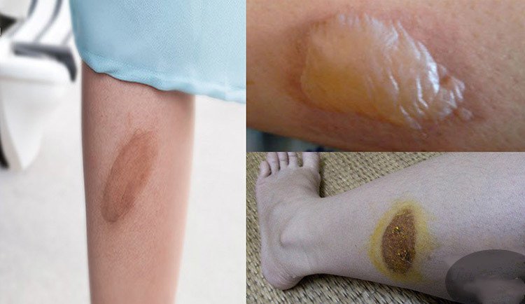 Sơ cứu vết bỏng nhẹ bằng cách làm mát da